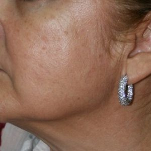 blanqueamineto-facial-antes-salud-y-laser