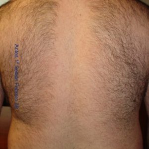 depilacion-espalda-antes-salud-y-laser
