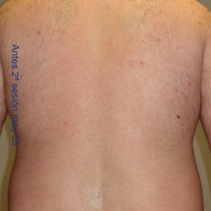 depilacion-espalda-despues-salud-y-laser